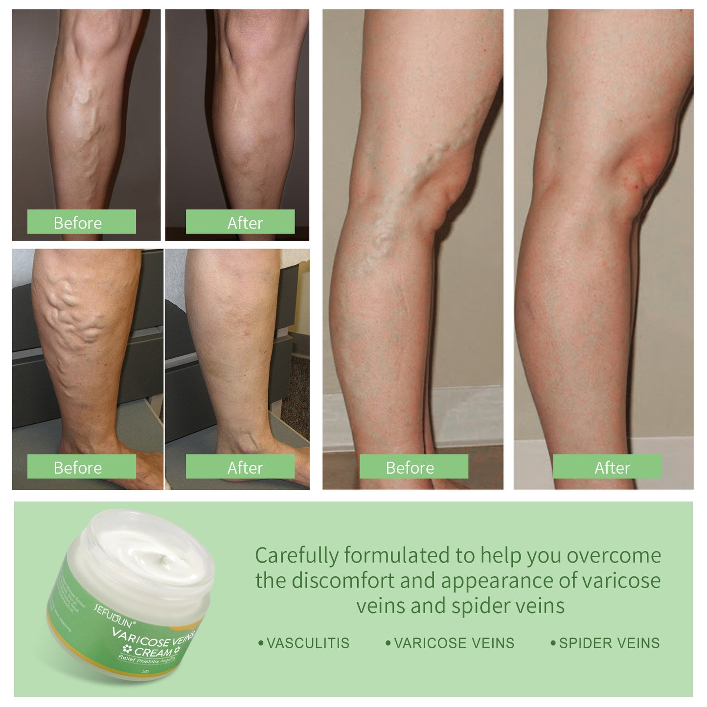 Creme Varizes e Derrames (Varicose Veins)