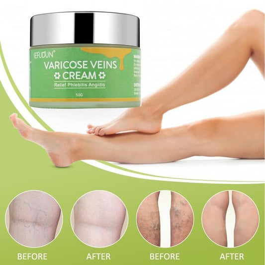 Creme Varizes e Derrames (Varicose Veins)